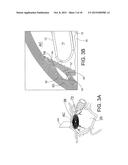 APPARATUS FOR DELIVERING OCULAR IMPLANTS INTO AN ANTERIOR CHAMBER OF THE     EYE diagram and image