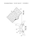 APPARATUS FOR DELIVERING OCULAR IMPLANTS INTO AN ANTERIOR CHAMBER OF THE     EYE diagram and image