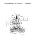 APPARATUS FOR GENERATION OF A PRESSURE PULSE IN TISSUE diagram and image