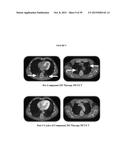 TREATMENT OF CANCERS USING PI3 KINASE ISOFORM MODULATORS diagram and image