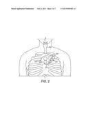 Respiration Sensors For Recording Of Triggered Respiratory Signals In     Neurostimulators diagram and image