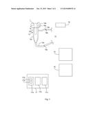 MILKING ARRANGEMENT, SET OF EXCHANGEABLE EXPENDABLE PARTS AND METHOD FOR A     MILKING ARRANGEMENT diagram and image