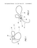 MULTIPLE LOOP SURGICAL SNARE ASSEMBLY AND SUTURING METHODS THEREOF diagram and image