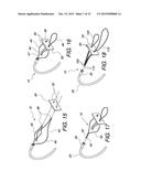 MULTIPLE LOOP SURGICAL SNARE ASSEMBLY AND SUTURING METHODS THEREOF diagram and image