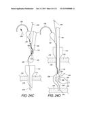 MULTIPLE LOOP SURGICAL SNARE ASSEMBLY AND SUTURING METHODS THEREOF diagram and image