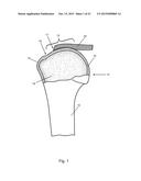 Arthroscopic Method and Apparatus for Rotator Cuff Repair diagram and image