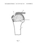 Arthroscopic Method and Apparatus for Rotator Cuff Repair diagram and image