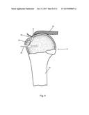 Arthroscopic Method and Apparatus for Rotator Cuff Repair diagram and image