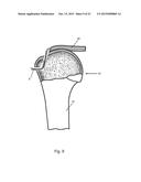 Arthroscopic Method and Apparatus for Rotator Cuff Repair diagram and image