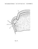 Arthroscopic Method and Apparatus for Rotator Cuff Repair diagram and image