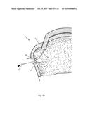 Arthroscopic Method and Apparatus for Rotator Cuff Repair diagram and image