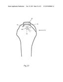 Arthroscopic Method and Apparatus for Rotator Cuff Repair diagram and image