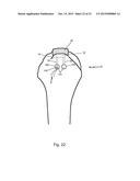 Arthroscopic Method and Apparatus for Rotator Cuff Repair diagram and image