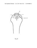 Arthroscopic Method and Apparatus for Rotator Cuff Repair diagram and image