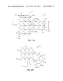 INTRAVASCULAR DEVICES SUPPORTING AN ARTERIOVENOUS FISTULA diagram and image