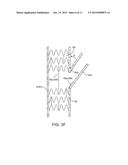 INTRAVASCULAR DEVICES SUPPORTING AN ARTERIOVENOUS FISTULA diagram and image