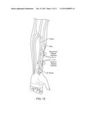 INTRAVASCULAR DEVICES SUPPORTING AN ARTERIOVENOUS FISTULA diagram and image