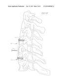 REVISABLE ANTERIOR CERVICAL PLATING SYSTEM diagram and image