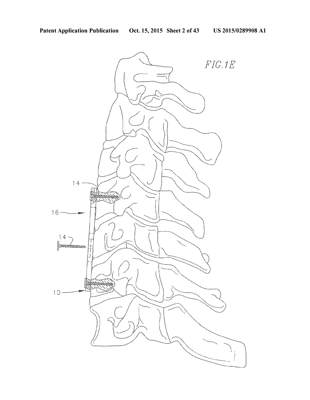 REVISABLE ANTERIOR CERVICAL PLATING SYSTEM - diagram, schematic, and image 03