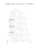 REVISABLE ANTERIOR CERVICAL PLATING SYSTEM diagram and image