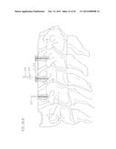 REVISABLE ANTERIOR CERVICAL PLATING SYSTEM diagram and image