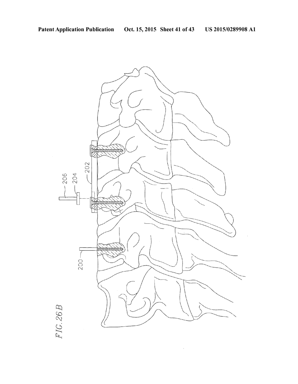 REVISABLE ANTERIOR CERVICAL PLATING SYSTEM - diagram, schematic, and image 42