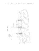 REVISABLE ANTERIOR CERVICAL PLATING SYSTEM diagram and image