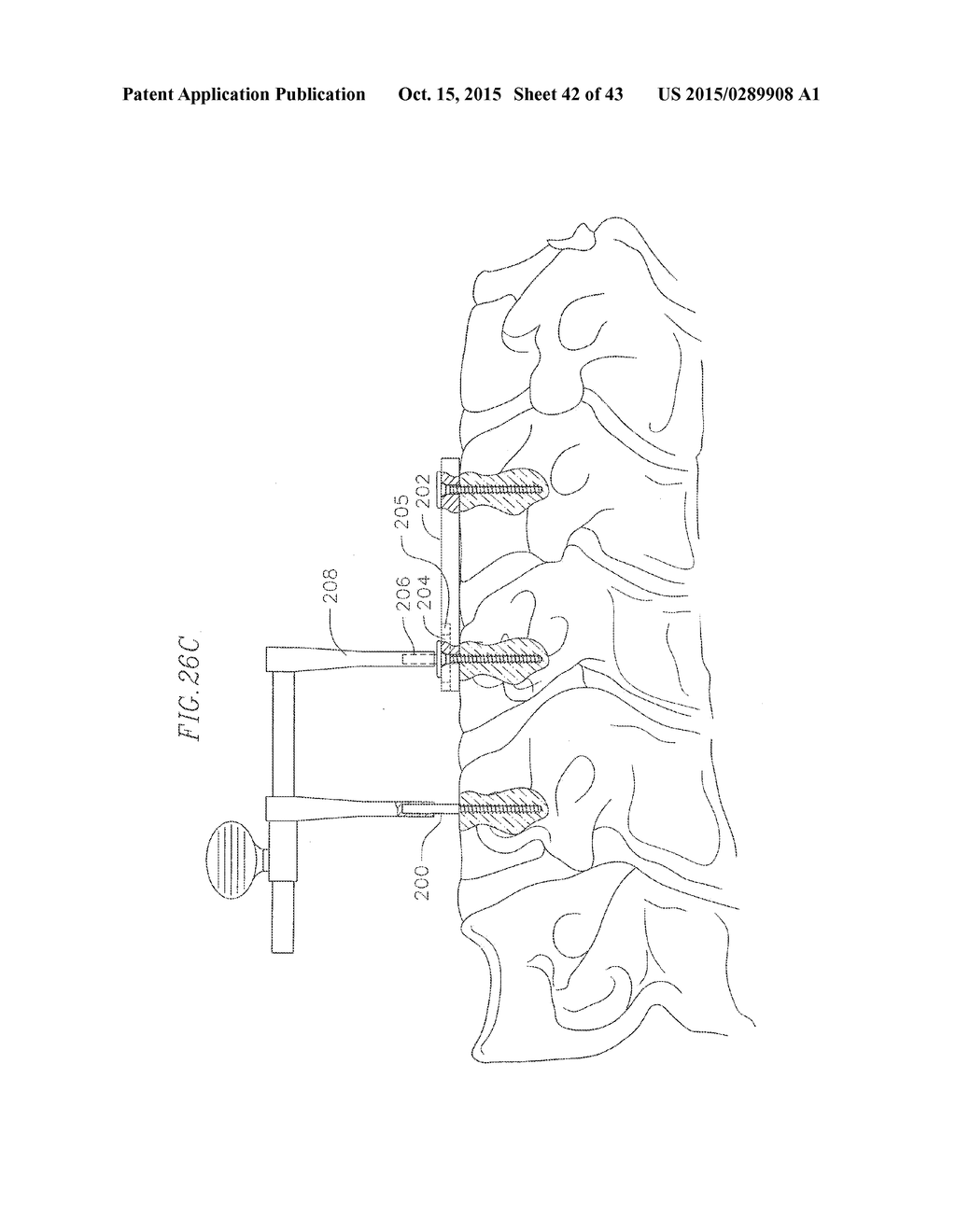 REVISABLE ANTERIOR CERVICAL PLATING SYSTEM - diagram, schematic, and image 43