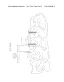 REVISABLE ANTERIOR CERVICAL PLATING SYSTEM diagram and image