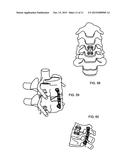 SPINE STABILIZATION diagram and image