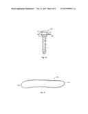 Bone Anchor diagram and image