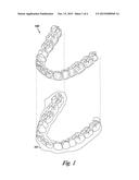 TABBED DENTAL APPLIANCE diagram and image