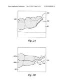 TABBED DENTAL APPLIANCE diagram and image