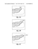 TABBED DENTAL APPLIANCE diagram and image