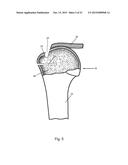 Arthroscopic Method and Apparatus for Rotator Cuff Repair diagram and image