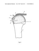 Arthroscopic Method and Apparatus for Rotator Cuff Repair diagram and image