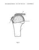 Arthroscopic Method and Apparatus for Rotator Cuff Repair diagram and image