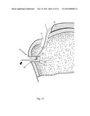 Arthroscopic Method and Apparatus for Rotator Cuff Repair diagram and image