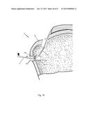 Arthroscopic Method and Apparatus for Rotator Cuff Repair diagram and image