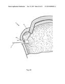 Arthroscopic Method and Apparatus for Rotator Cuff Repair diagram and image