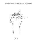 Arthroscopic Method and Apparatus for Rotator Cuff Repair diagram and image