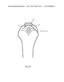 Arthroscopic Method and Apparatus for Rotator Cuff Repair diagram and image