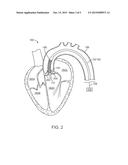 PROFILE ALTERING TIP FOR A DELIVERY SYSTEM diagram and image