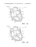 Reinforced Prosthetic Tissue Valves diagram and image