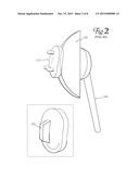 Total Shoulder Arthroplasty Prosthesis diagram and image