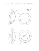 Total Shoulder Arthroplasty Prosthesis diagram and image