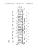 STENT diagram and image