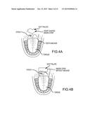 Non-Surgical Method and System for Reducing Snoring diagram and image