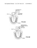 Non-Surgical Method and System for Reducing Snoring diagram and image