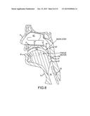 Non-Surgical Method and System for Reducing Snoring diagram and image